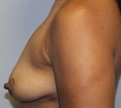 Before & After Photos Breast Explant