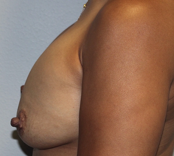 Before and after plastic surgery results in Dallas, TX, performed by Dr. Surjit Rai, MD.