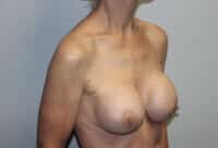 Before & After Photos: Breast Explant with Lift or Reduction