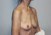 Before & After Photos: Breast Explant with Lift or Reduction
