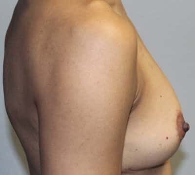 Before & After Photos: Breast Explant with Lift or Reduction