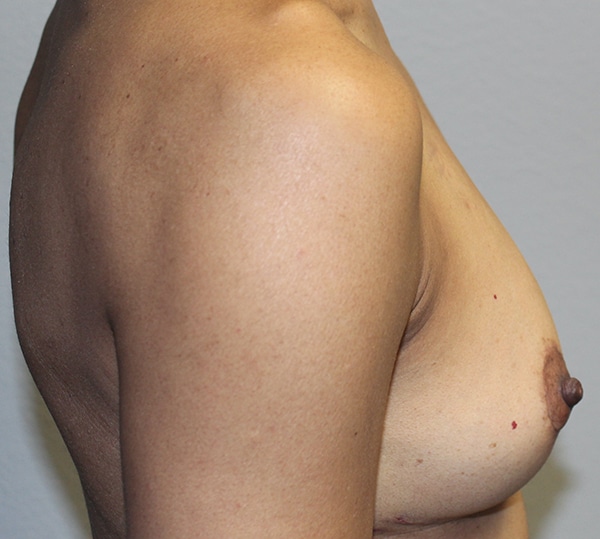 Before and after plastic surgery results in Dallas, TX, performed by Dr. Surjit Rai, MD.