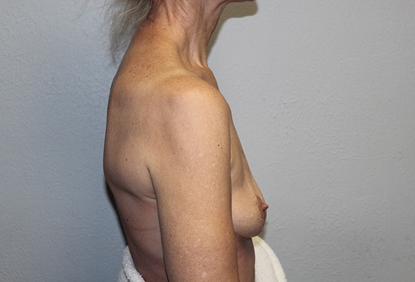 Before and after plastic surgery results in Dallas, TX, performed by Dr. Surjit Rai, MD.