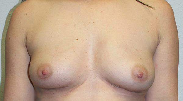 Before and after plastic surgery results in Dallas, TX, performed by Dr. Surjit Rai, MD.