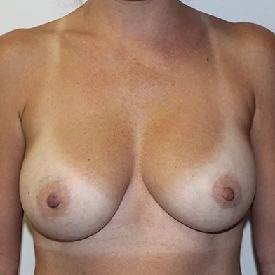 Before and after plastic surgery results in Dallas, TX, performed by Dr. Surjit Rai, MD.