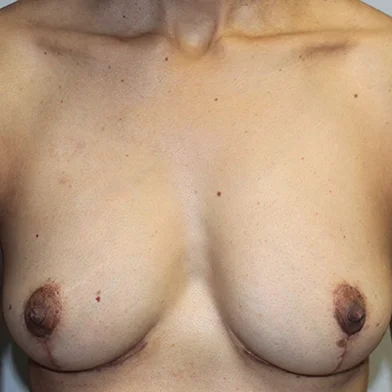 Before and after plastic surgery results in Dallas, TX, performed by Dr. Surjit Rai, MD.