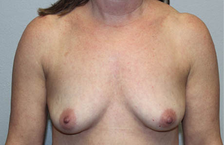 1_0007_case2after (3).JPG