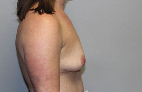 1_0009_case2after (1).JPG