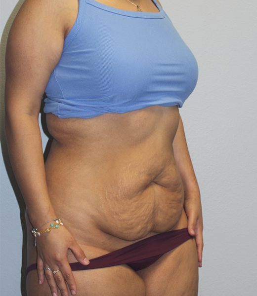 pre tummy (3).JPG